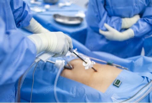 Laparoscopic Cholecystectomy 
