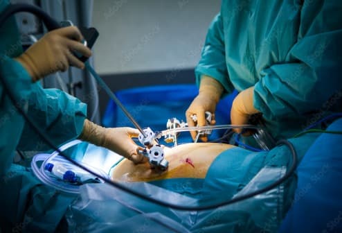 Laparoscopic Hysterectomy